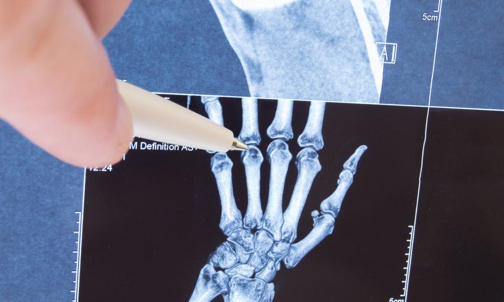 Mikor forduljon orvoshoz ízületi fájdalmával? Zsibbadt kezek rheumatoid arthritisben